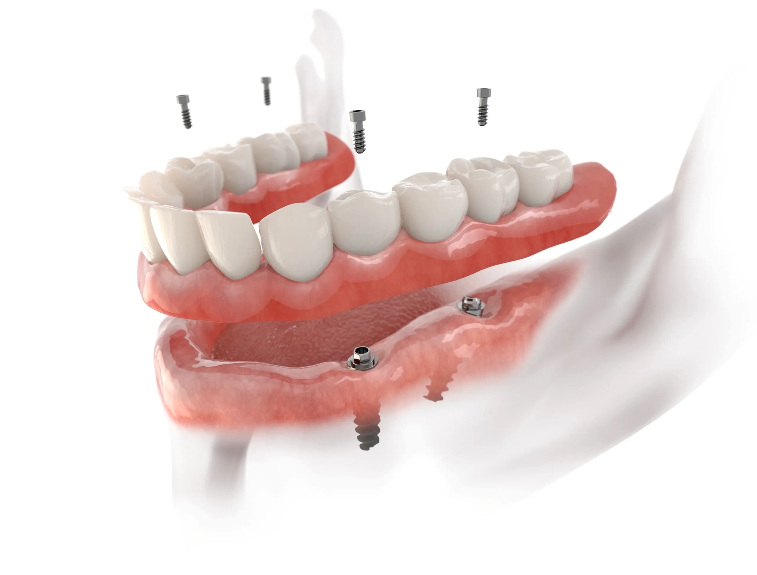 Implant-supported snap-in denture demonstration