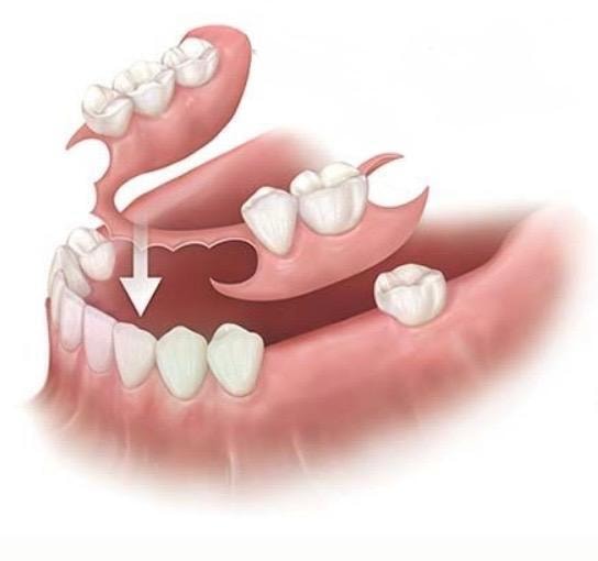 Partial Dentures dental prosthetic