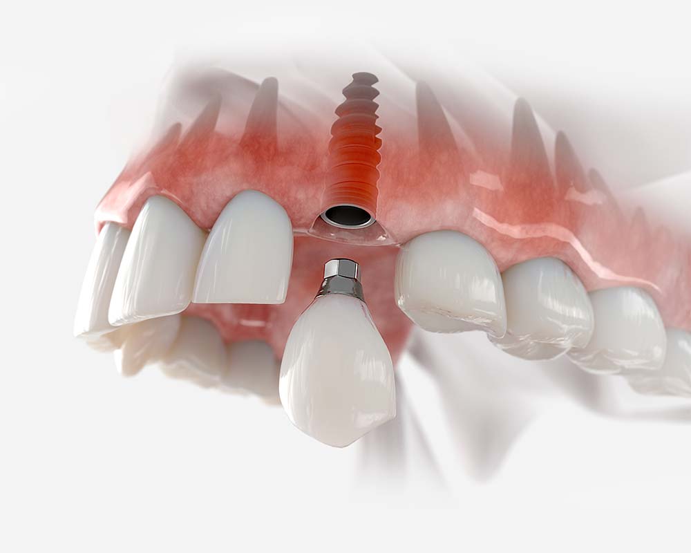 Dental implants service