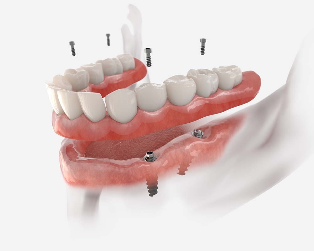 Dentures and partials dental service